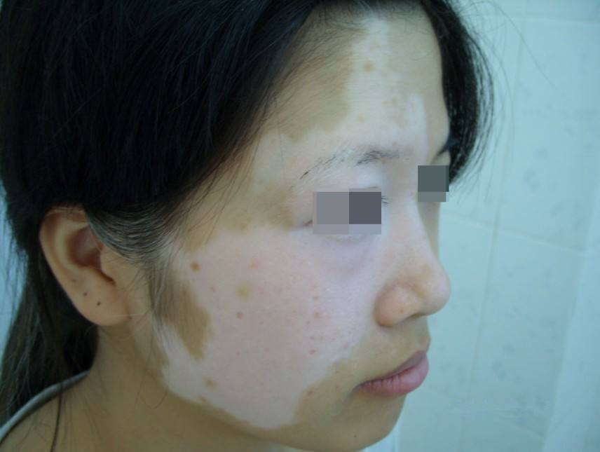 散发型白癜风应该怎样治疗呢