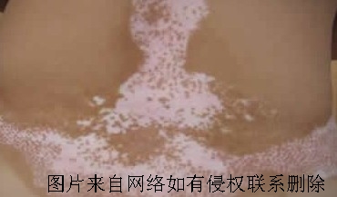 影响白癜风治疗效果的因素有哪些呢
