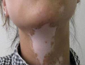 患上白癜风要怎么进行调理