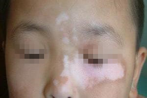 白癜风的症状应该如何缓解
