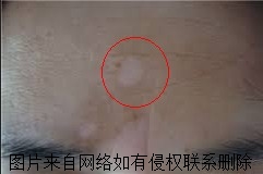 白癜风治疗的费用受什么影响