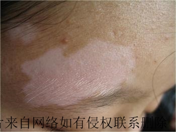 身上出现白斑怎么诊断是不是白癜风