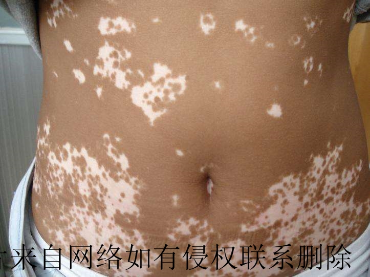 白癜风怎么治疗效果会更好