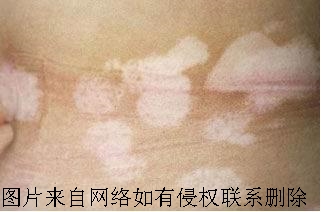 常见的白癜风有何症状