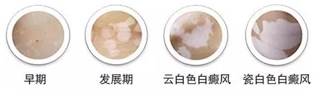 后期白癜风的症状会是怎样的表现
